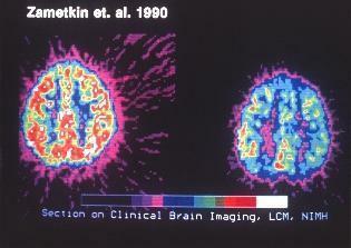 סריקת הדמיה מוחית קלינית לצורך בדיקת ADHD