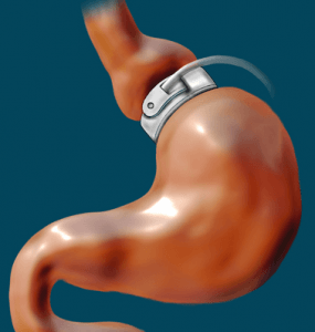 Lap-Band הוא דוגמה אחת לסוג אחד של ניתוחי קיבה שניתן להשתמש בהם לטיפול בהפרעות אכילה בולמוס.